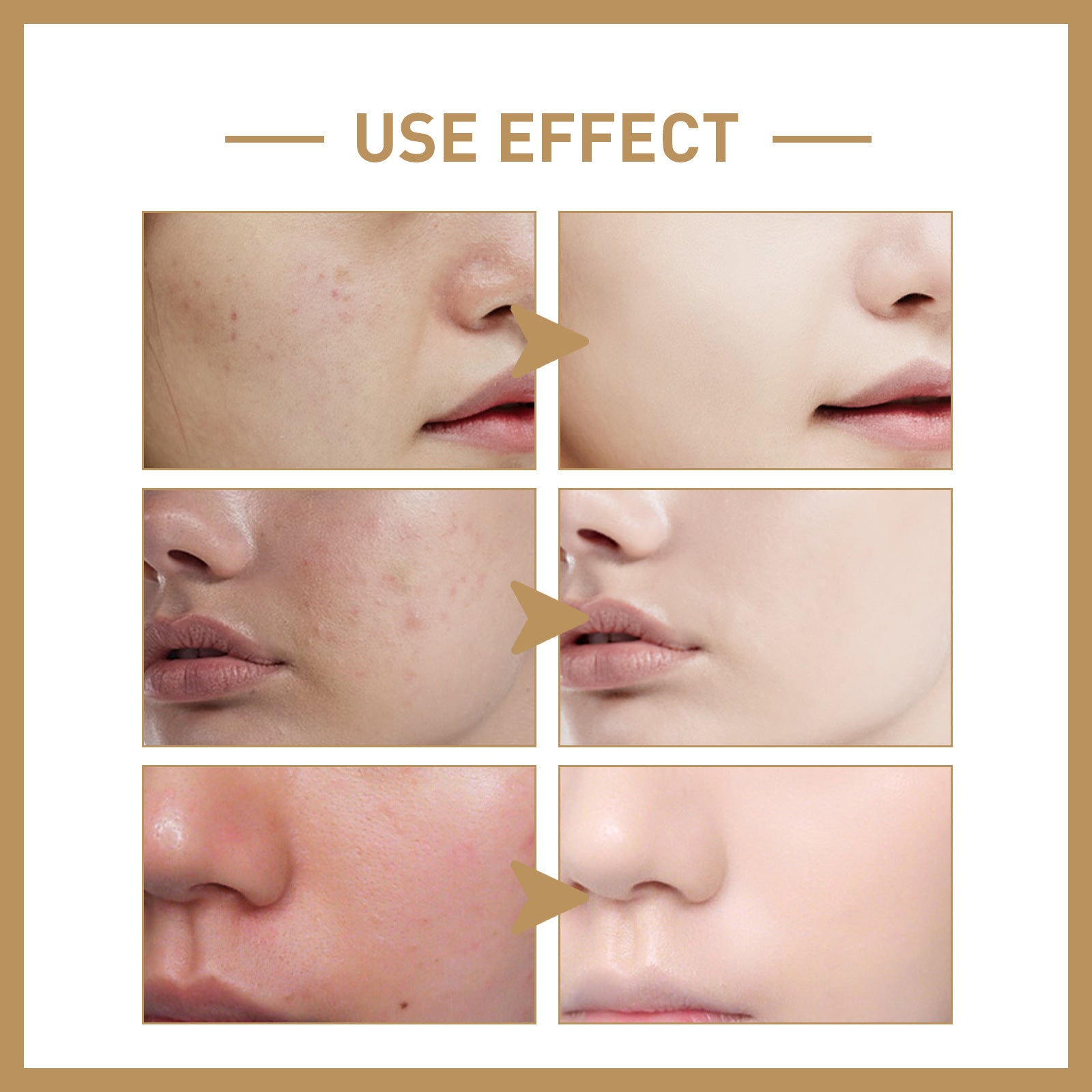 EELHOE Rice Lotion Deep Acne Hydrating Repair Skin Barrier